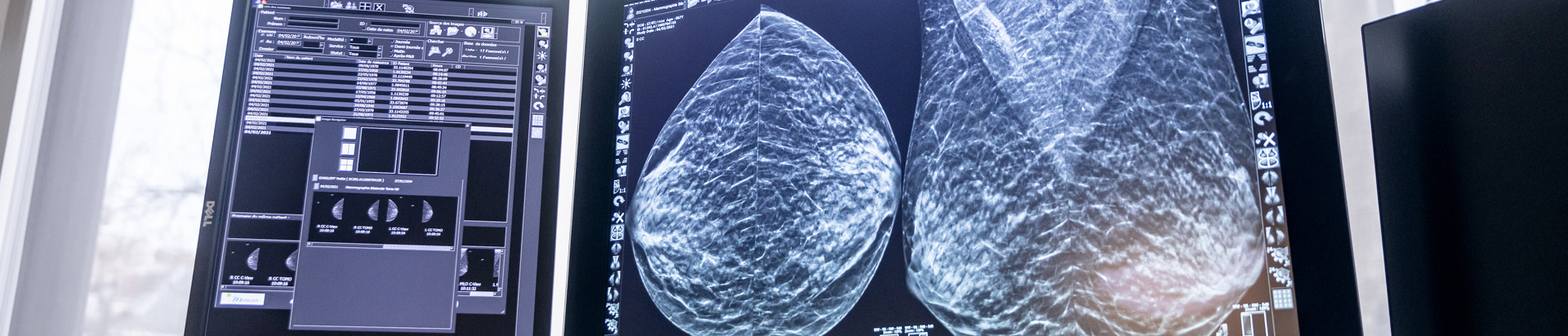 Microbiopsie Mammaire Radiologie Mim